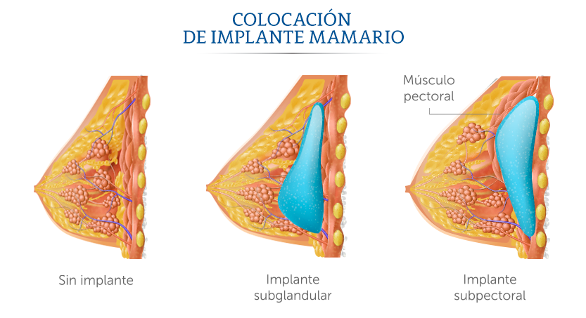 Ilustracin de colocacin de implante mamario.