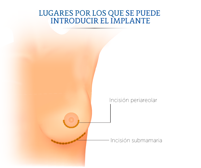Ilustracin de los lugares en donde se hace la incisin para introducir el implante mamario.