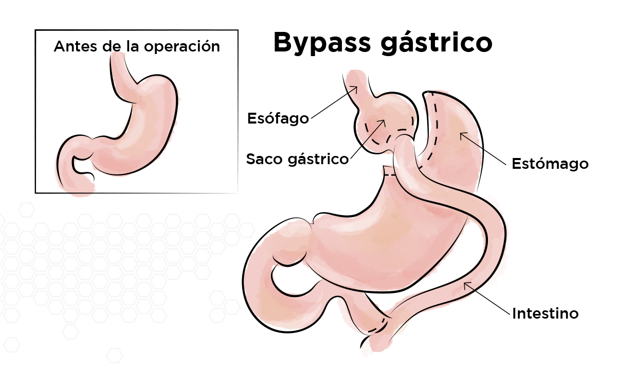 Bypass gástrico