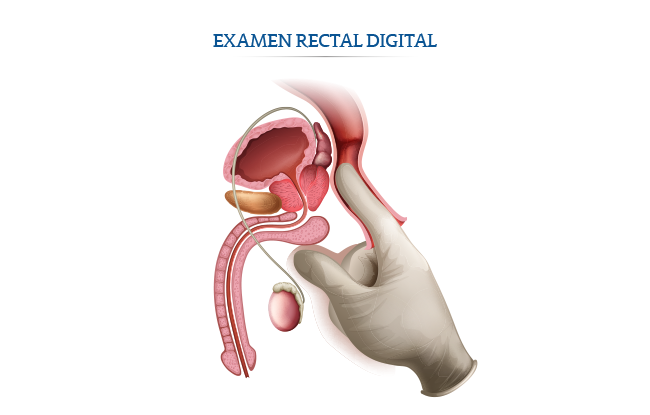 examen rectal digital