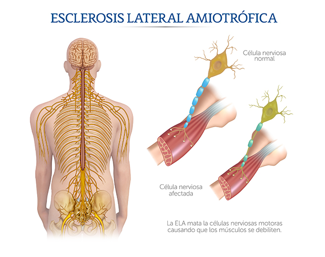 Ilustracin de la Esclerosis Lateral Atrfica
