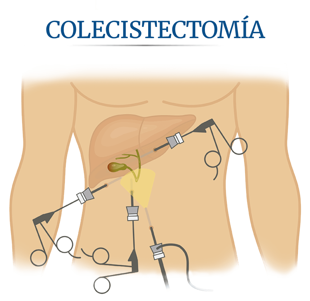 Clculos en la vescula, colecistectoma o ciruga de la vescula biliar