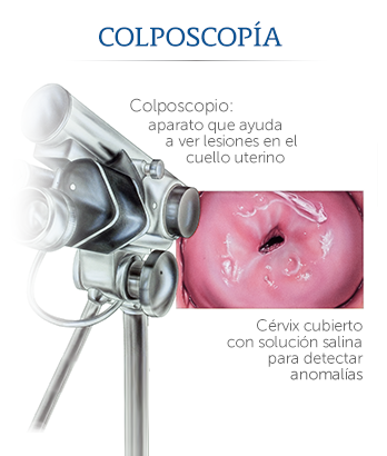 Que examen detecta el papiloma humano en mujeres