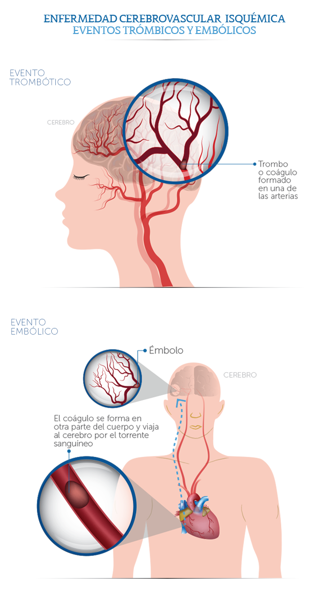 Patologìa vascular cerebral