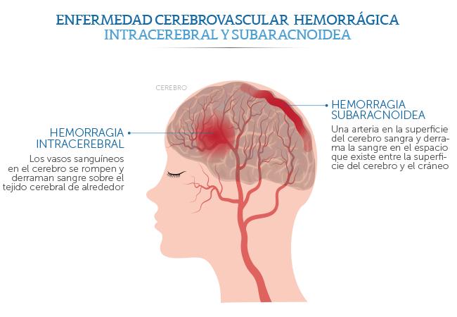 Patologìa vascular cerebral