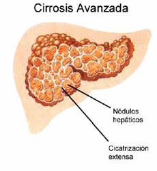 como tratar cirrosis hepatica
