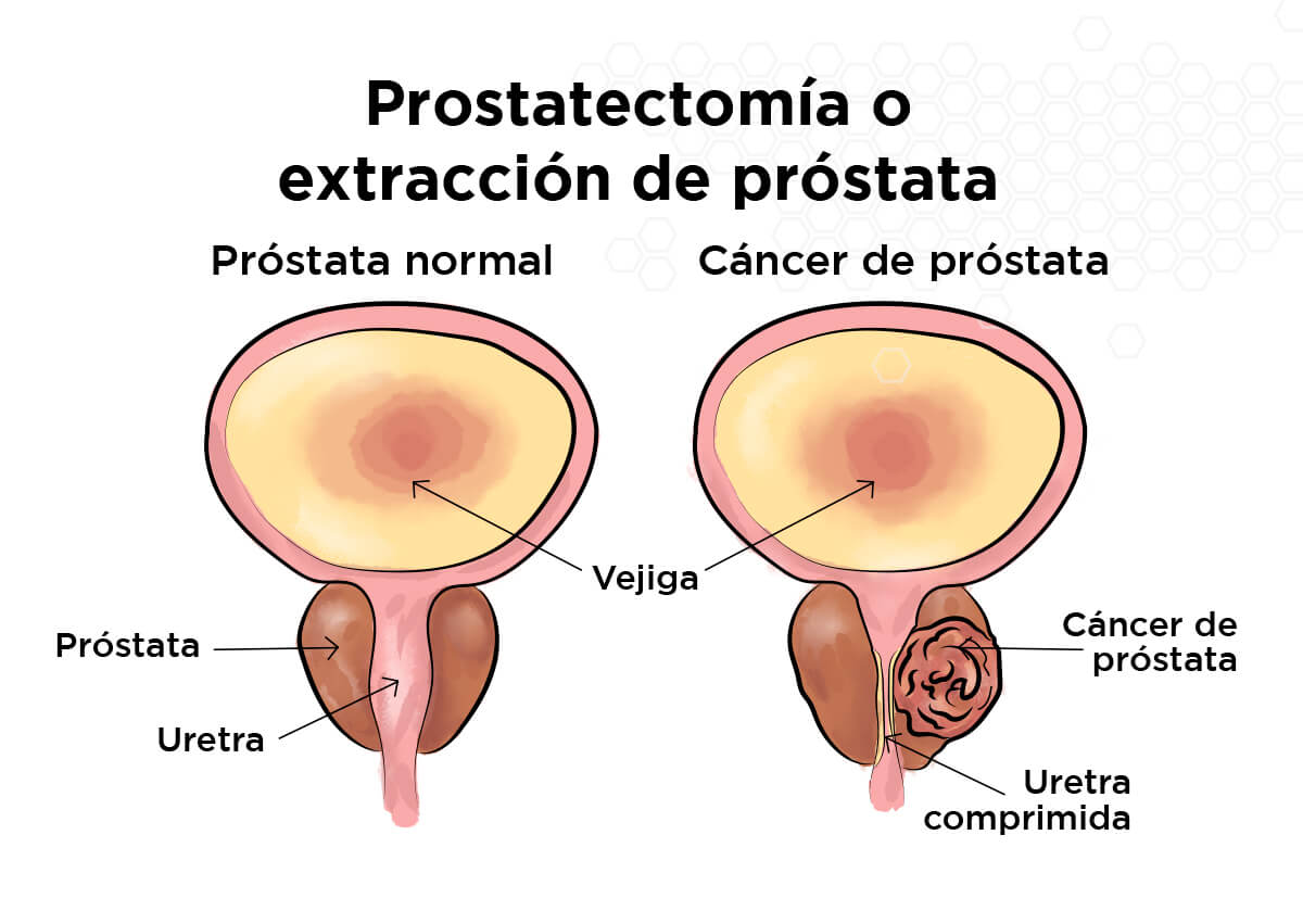 Prostatectomía o extracción de próstata