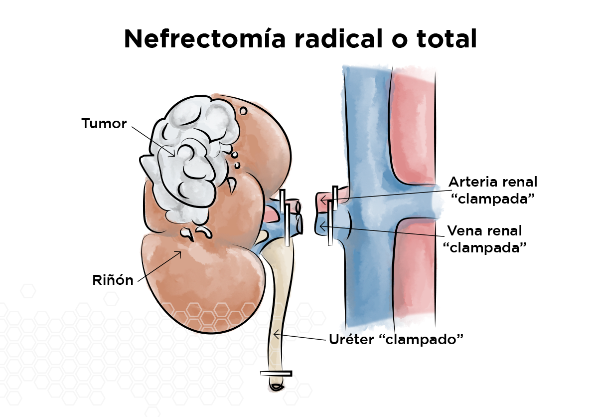 Nefrectomía radical o total