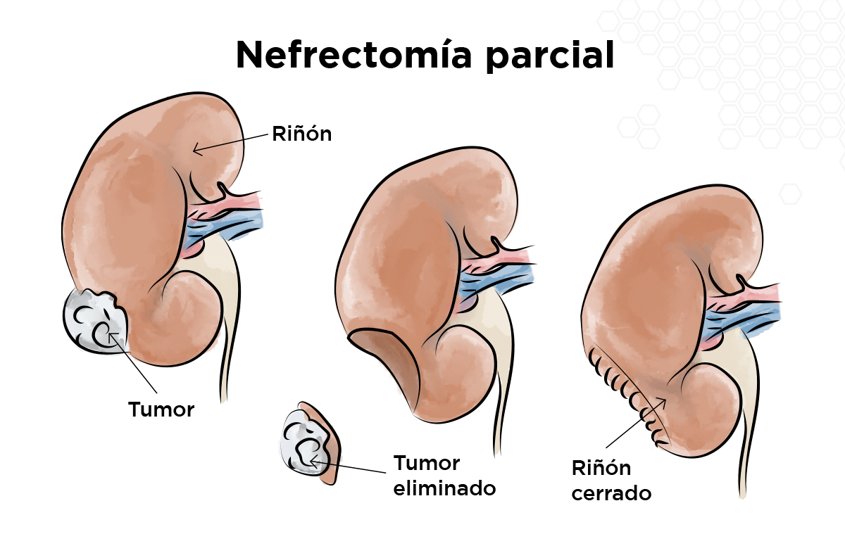 Nefrectomía parcial