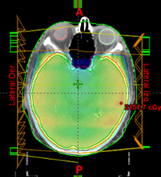 Sistema de planeación de tratamientos Eclipse v.15
