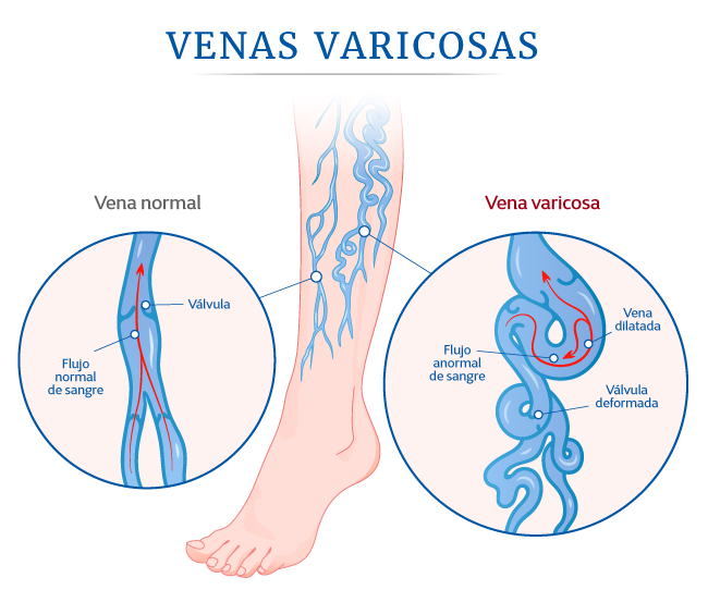 Venas varicosas