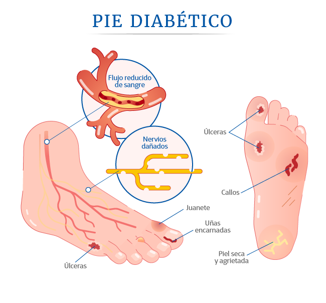 Pie del diabtico y salvamento de extremidad