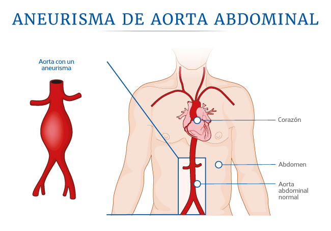 Aneurisma de aorta abdominal