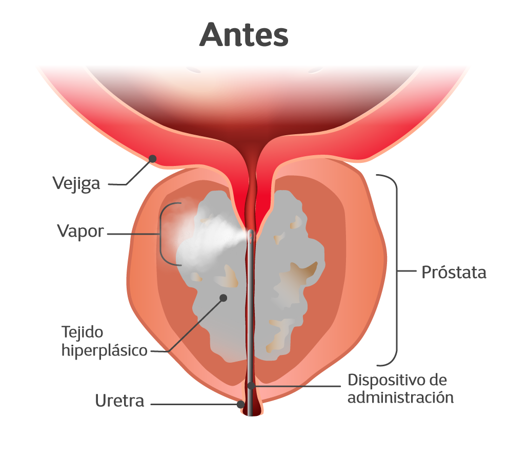 Como funciona REZUM