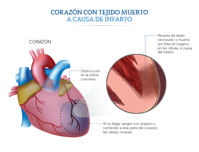 Tejido muerto causado por un infarto cardiaco