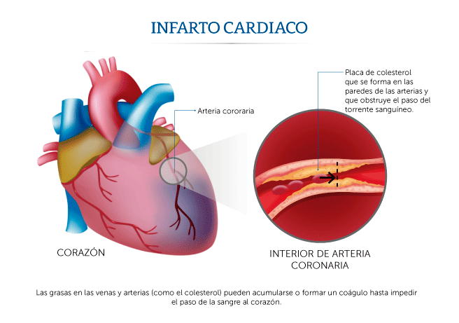 Ilustracin sobre cmo ocurre un infarto cardiaco