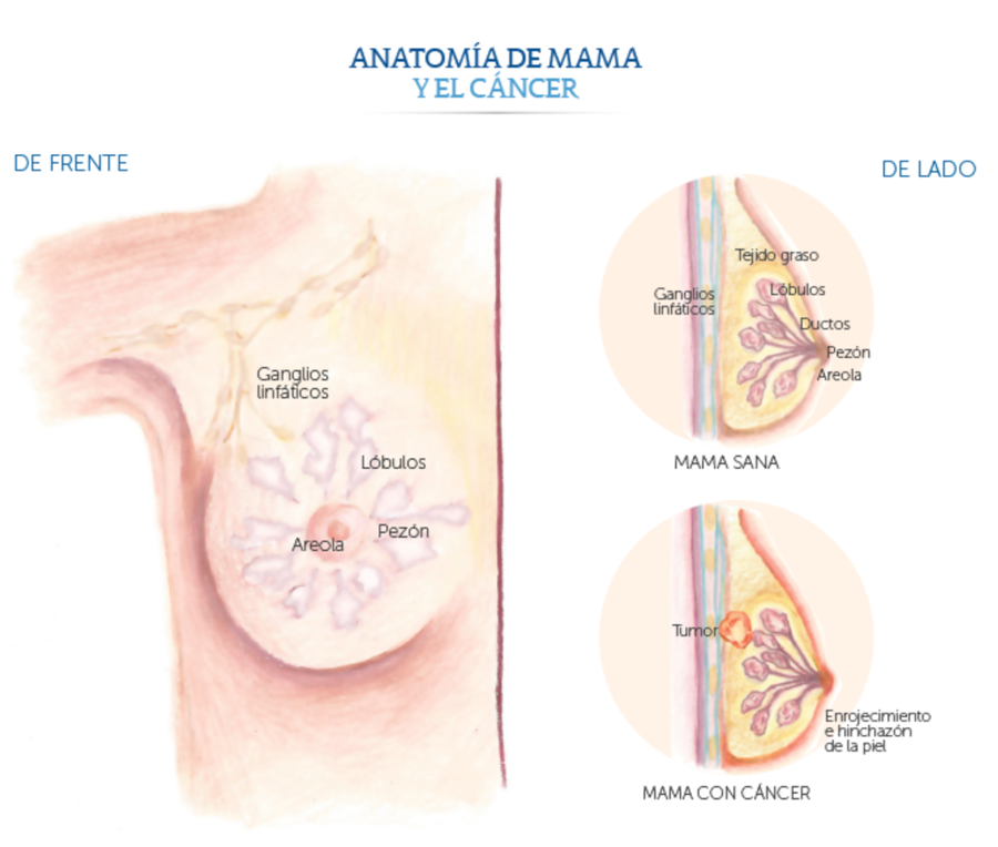 Medica Sur Cancer De Mama