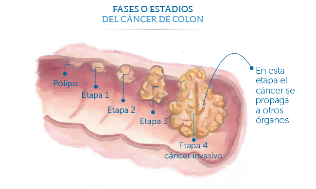 Cancer de colon etapas y sintomas