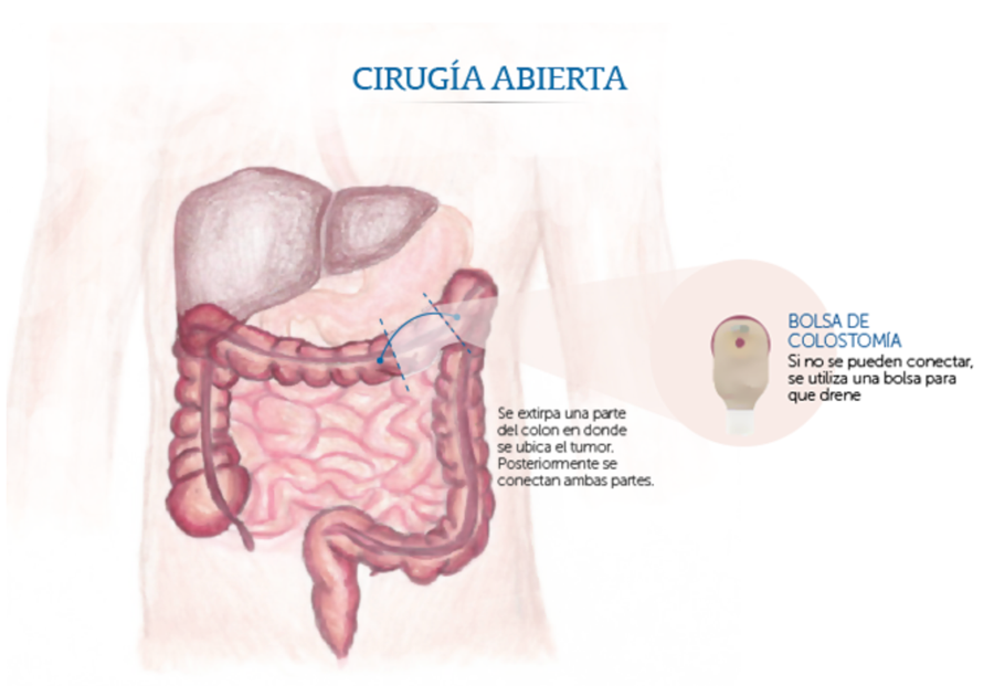 Ciruga abierta