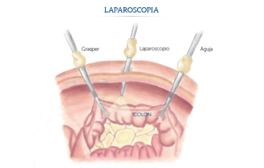 Laparoscopia