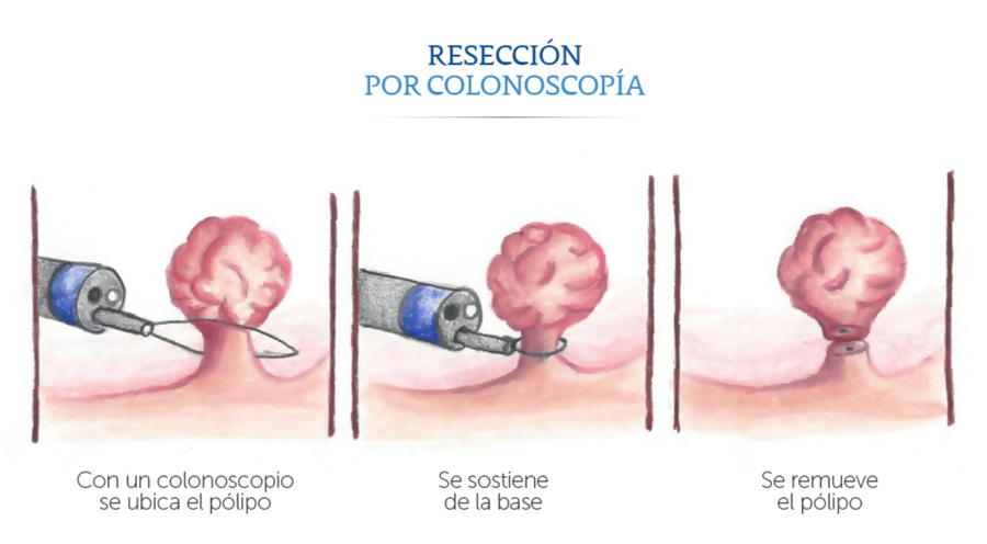 Reseccin por colonoscopa