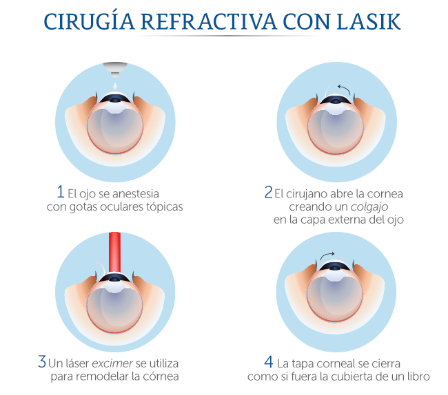 impacto Tentáculo Santo Médica Sur: Cirugía refractiva Lasik Excimer