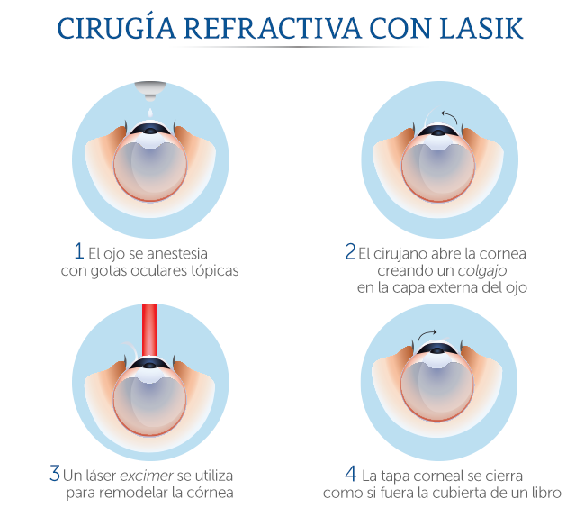 Esquema de ciruga con Lasik