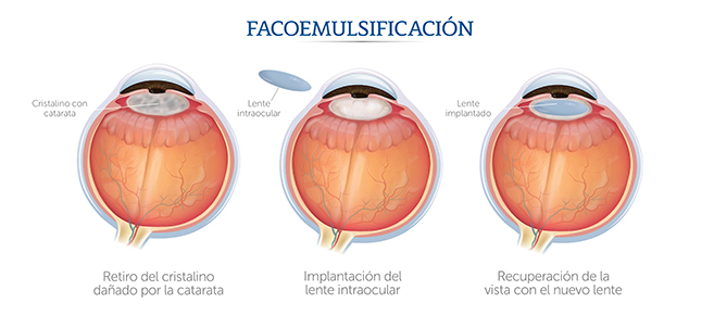 Fases de una ciruga de cataratas