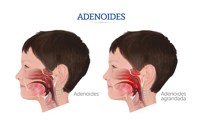 Ilustración del lugar que ocupan las adenoides