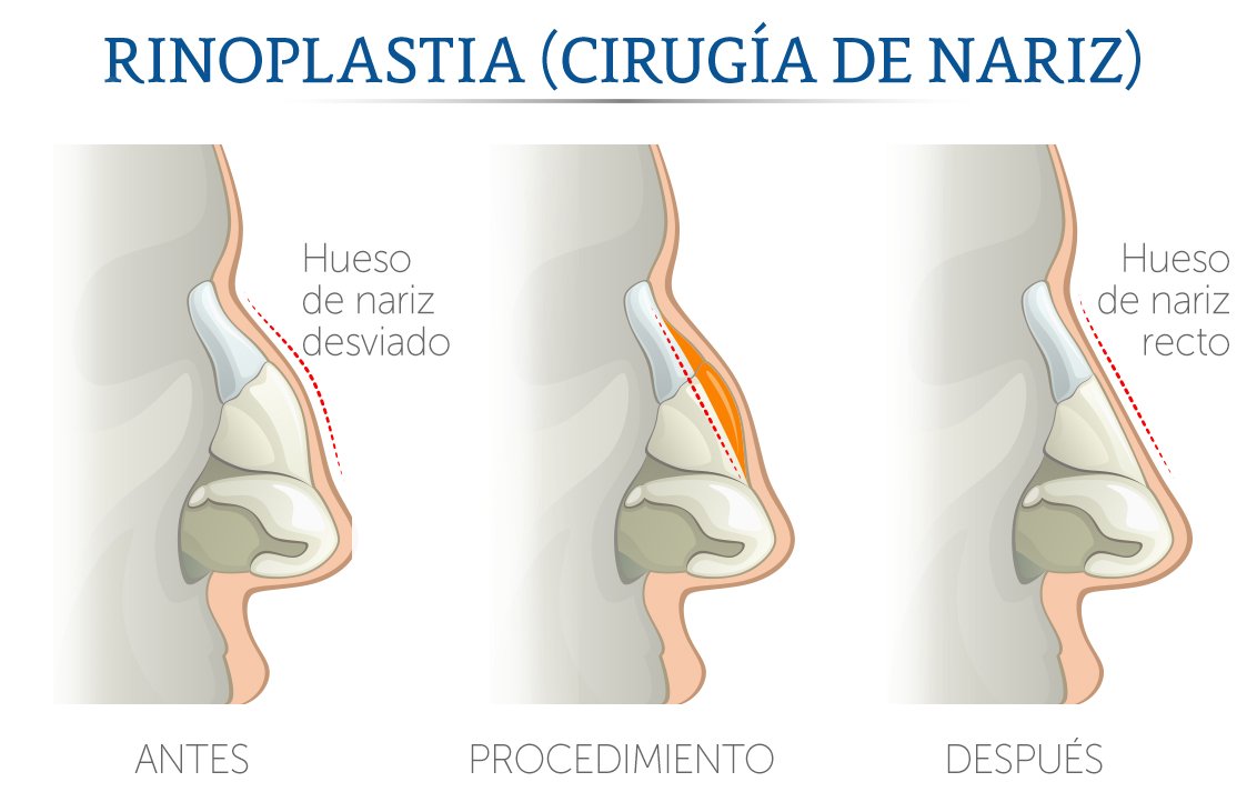 Ilustración de una cirugía de nariz