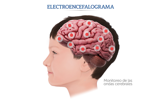 Infografía sobre el electroencefalograma