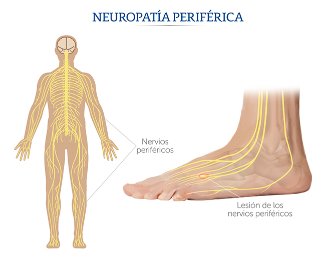 Nervios periféricos en la neuropatía periférica