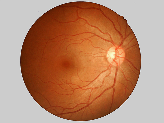 Vista del nervio &oacute;ptico.