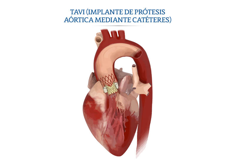 TAVI implante de prótesis aórtica mediante catéteres