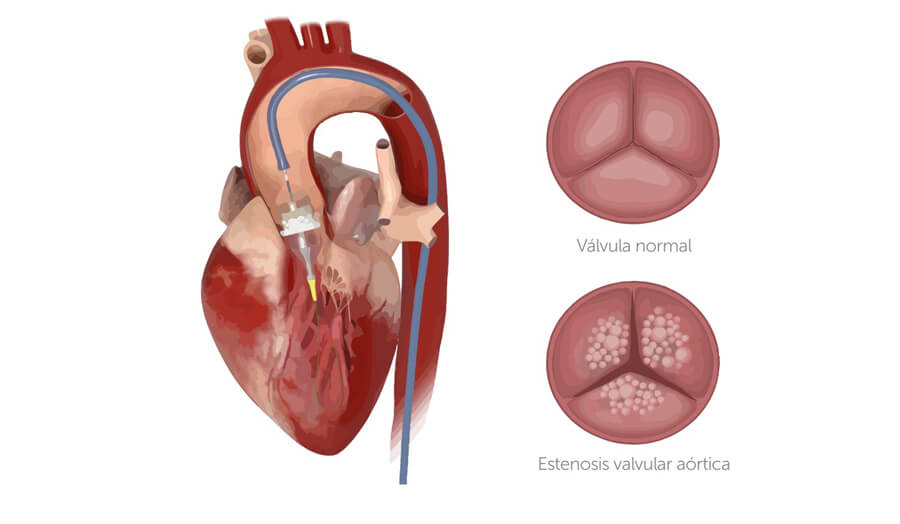 TAVI implante de prótesis aórtica mediante catéteres