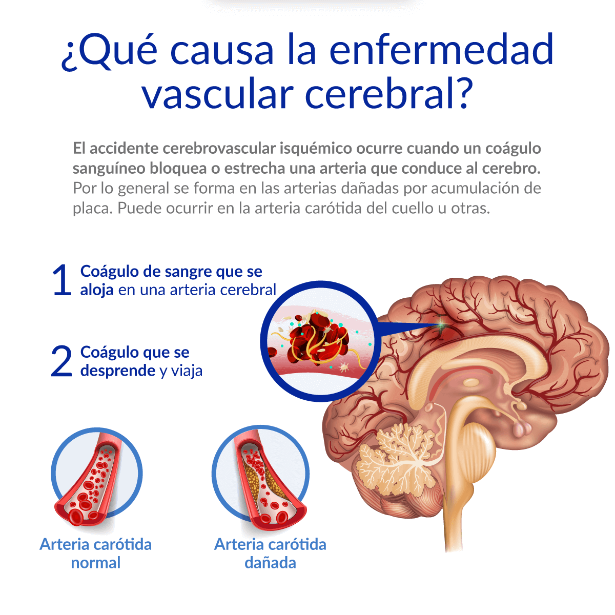 ¿Qué causa la enfermedad cerebro vascular?